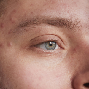 Understanding and Managing Acne Flare Ups